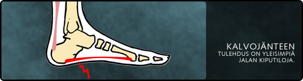 Tukipohjalliset plantarifaskiitin aiheuttamiin kiputiloihin ja luupiikin hoitoon